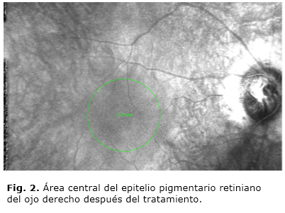Reinicio Retiniano: El Futuro del Tratamiento para la Ambliopía